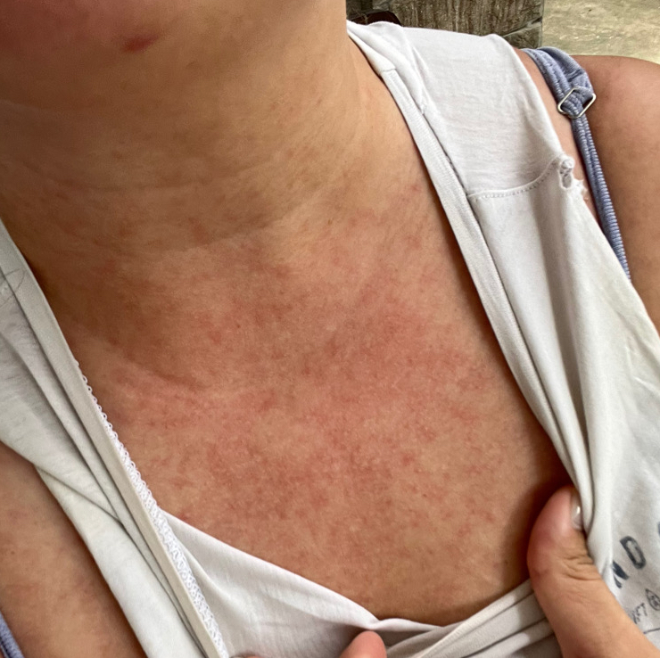 Fett hartnäckig? Darm checken!